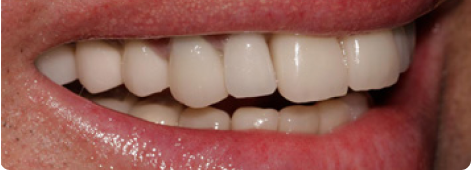 Melbourne’s Trusted Teeth Replacement Team Melbourne’s Trusted Teeth Replacement Team