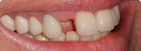 Melbourne’s Trusted Teeth Replacement Team Melbourne’s Trusted Teeth Replacement Team