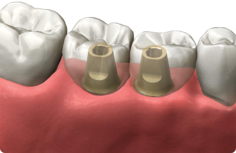 Multiple Implants Multiple Implants