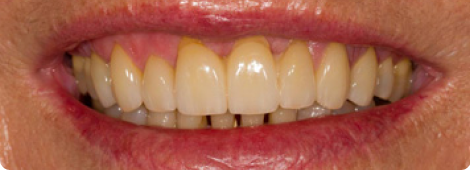 Porcelain Crowns after Porcelain Crowns after