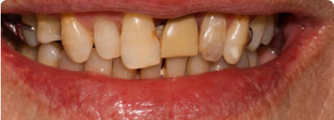 Porcelain Crowns before Porcelain Crowns before
