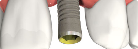 Single Implant Single Implant