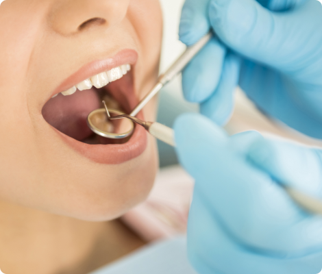 Tooth Coloured Fillings & Biomimetic Dentistry – conserve Tooth Coloured Fillings & Biomimetic Dentistry – conserve