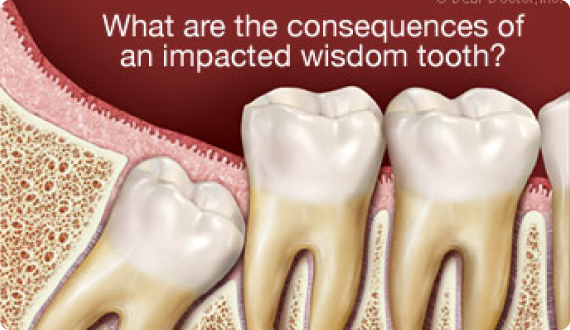 Wisdom Teeth Pain