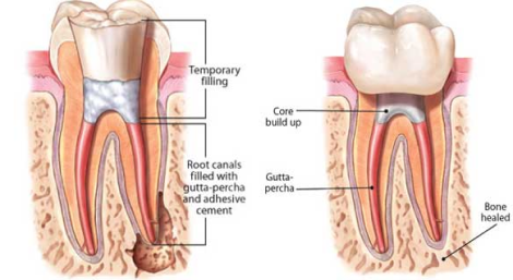 root canal treatment root canal treatment