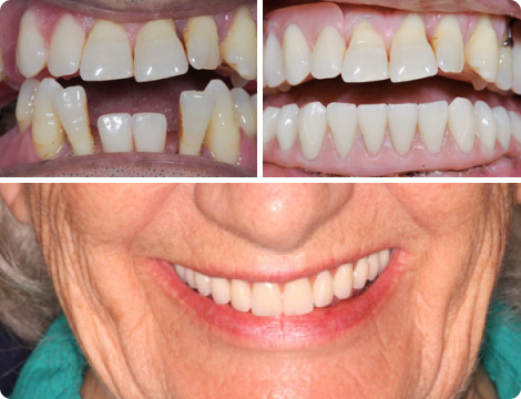 Affordable Dental Implants in Melbournee Affordable Dental Implants in Melbournee