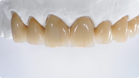 Are All Dental Crowns Made Equal