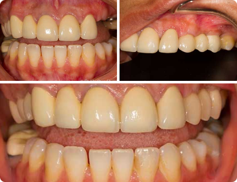 Case 5-Bone Grafting and