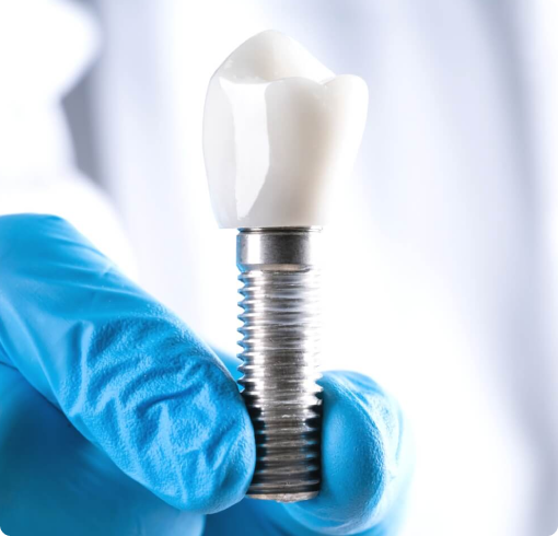Implants Implants