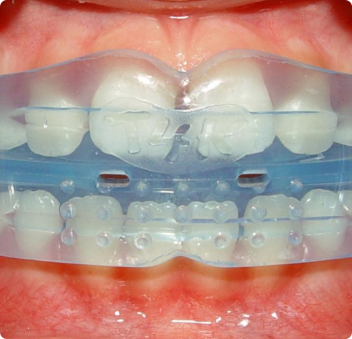 Myobrace Myobrace