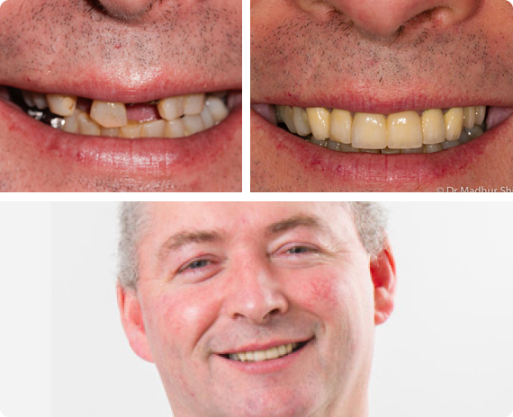 Oral Rehabilitation through Cosmetic Dentistry in Melbourne Oral Rehabilitation through Cosmetic Dentistry in Melbourne