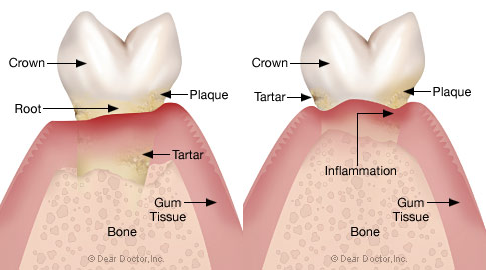 So what is Gum disease So what is Gum disease