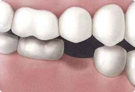 Step-1 Day One- Placement Of 4 To 6 Dental Implants