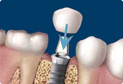 Step-3 Teeth Try-in