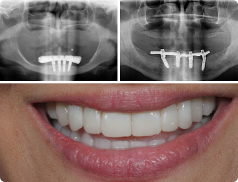 Tell me all About All on 4 Dental Implants Tell me all About All on 4 Dental Implants