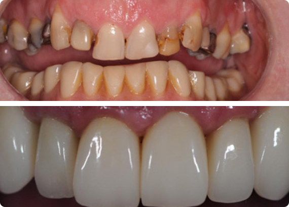 Affordable Single Dental Implants Affordable Single Dental Implants