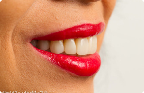 Major Advantages of Having Porcelain Veneers Major Advantages of Having Porcelain Veneers