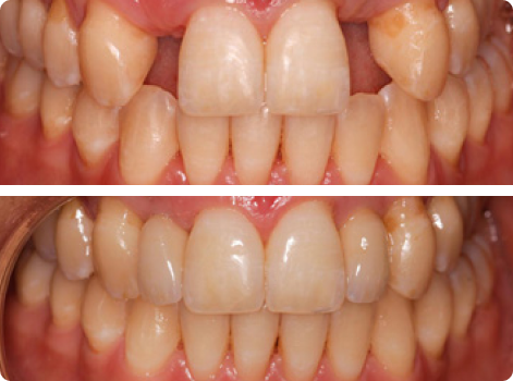 teeth replacement solution in Melbourne