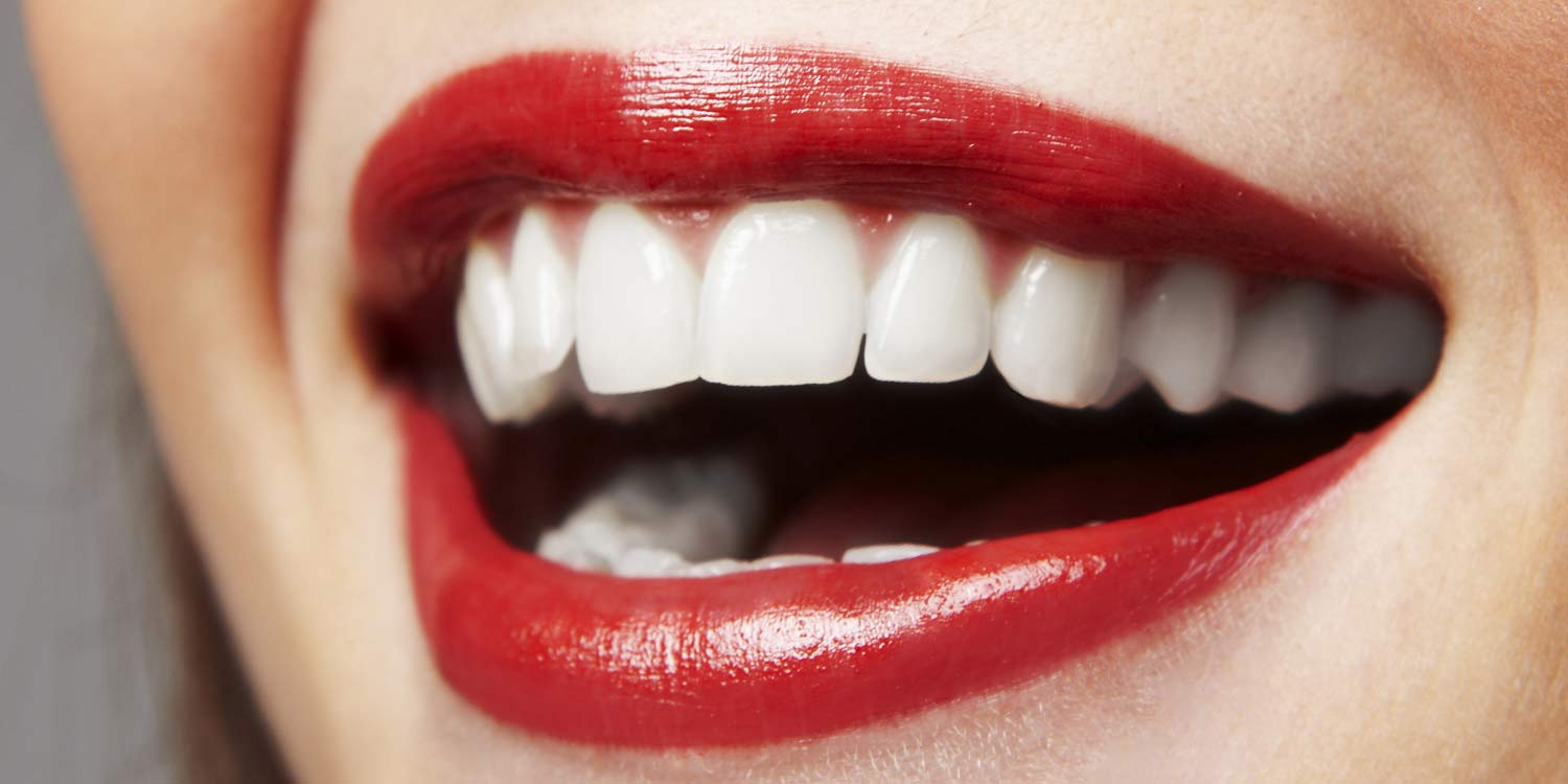 porcelain-veneers