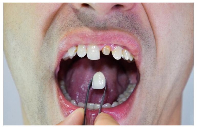 Causes For Cracked Teeth