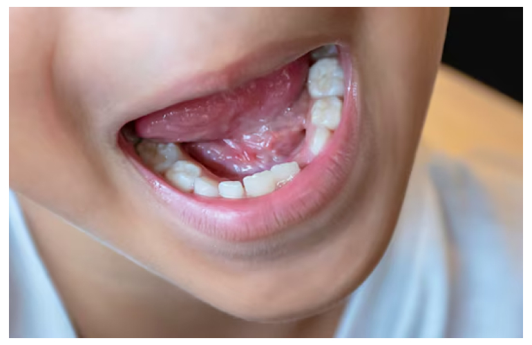 Consequences Of Having Gaps In Your Smile