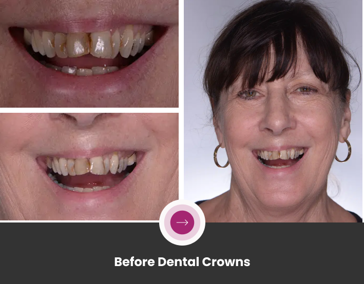 Kathleen’s Dental Crowns Journey