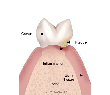 Gingivitis