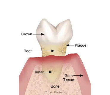 Advanced Periodontitis