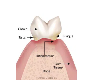 Early Periodontitis