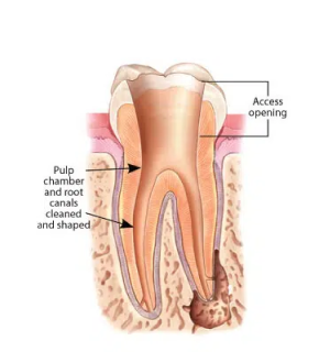 Pulp Chamber
