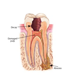 Abscess