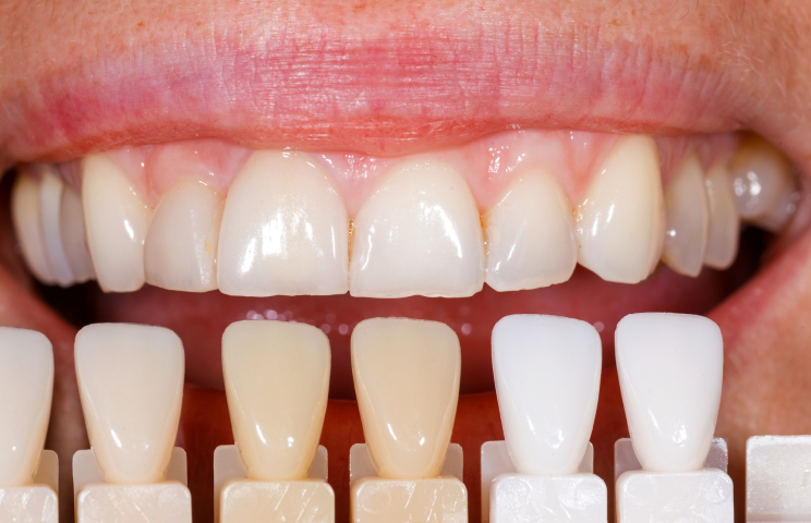 What Can Porcelain Veneers Improve?