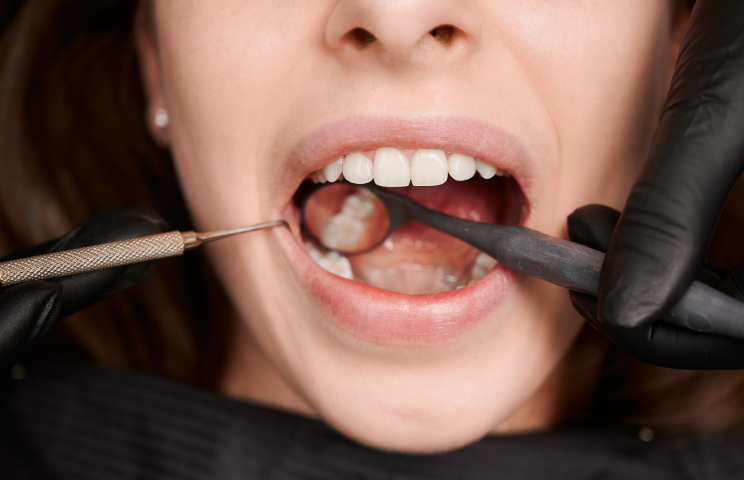 Composite Veneers Cost Melbourne