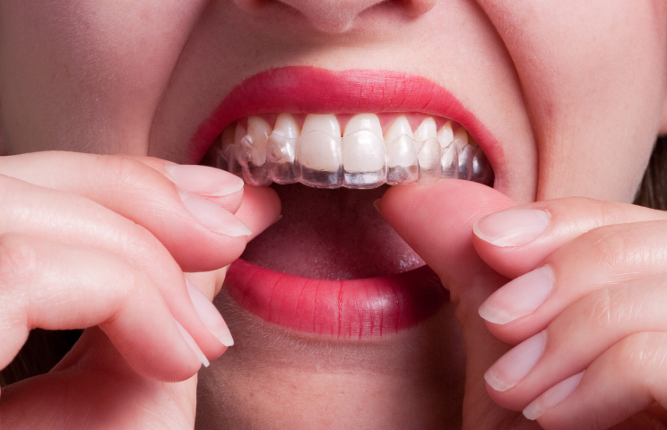 Best Invisalign Treatment Process in Melbourne