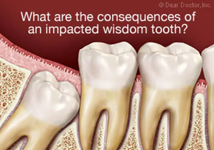 Suffering from wisdom teeth pain We are here to help!