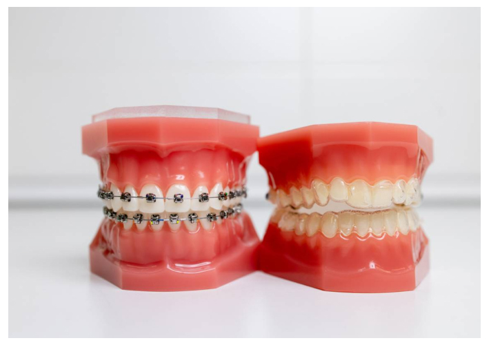 What’s Cheaper: Braces Or Invisalign