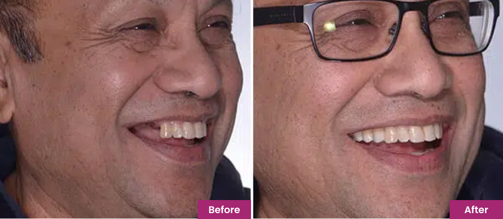 before after