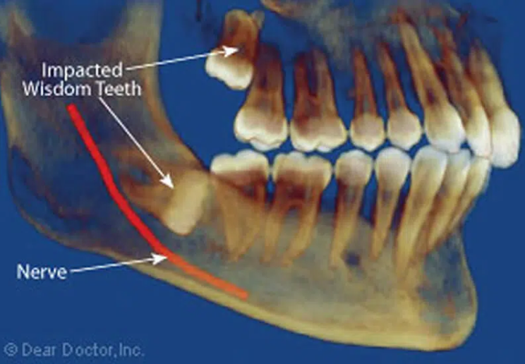 Why do wisdom teeth cause pain?