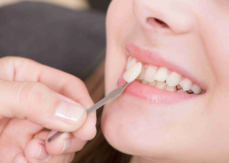 How Much Do Porcelain Veneers Cost?