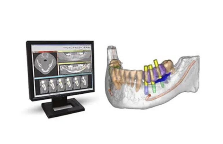 Full mouth x-ray and 3D CT scan of your jaw