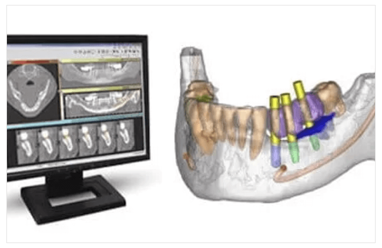 Dental Implant Treatment