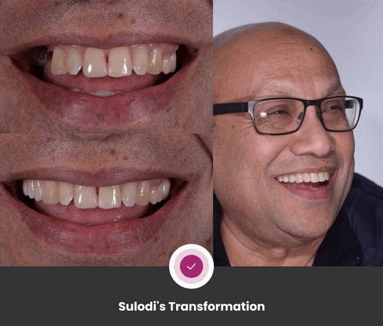 Dental Implants Transformations