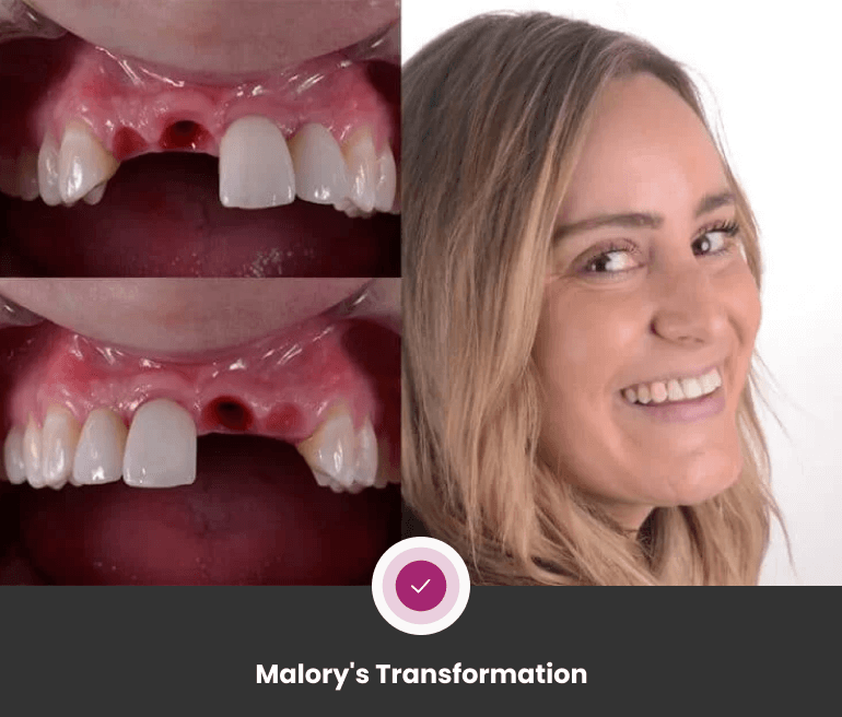 Quality Dental Implants