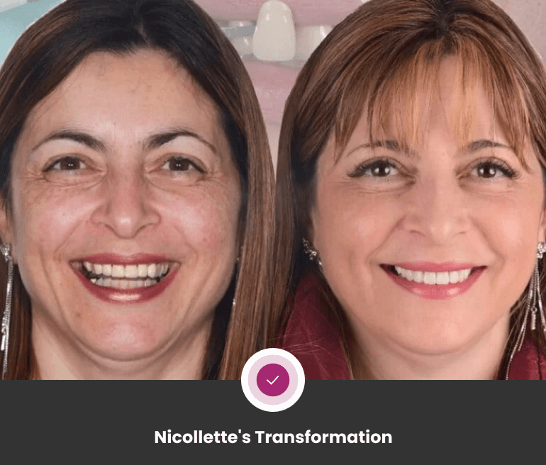 Dental Implants Transformations