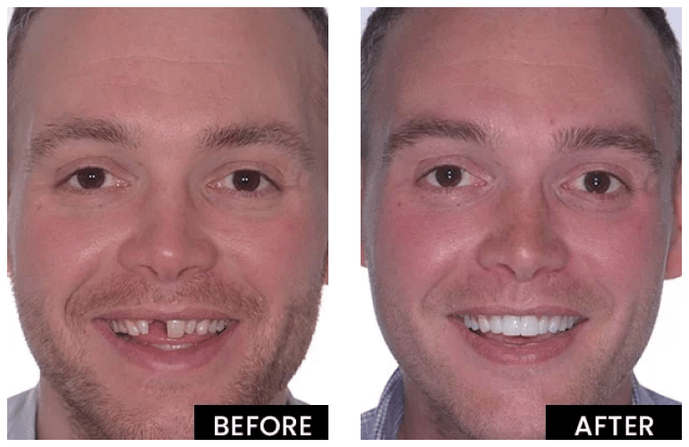 Dental Implants