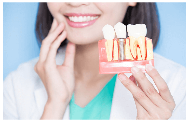 Teeth Implants
