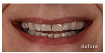 Veneers