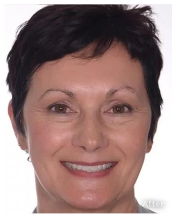 Veneers