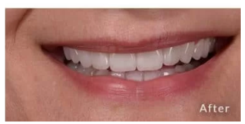 Veneers