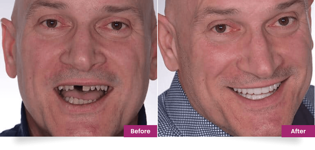 before after sliderbefore after slider